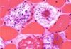 A new treatment for rare muscular disease