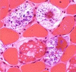 A new treatment for rare muscular disease