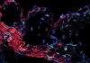 Gene Found to Play a Role in Atherosclerosis