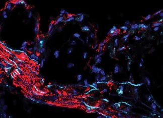 Gene Found to Play a Role in Atherosclerosis