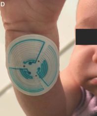 “Sweat Stickers” May Ease Cystic Fibrosis Diagnosis and Management