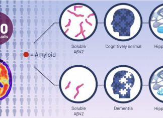 Study Proposes Increasing Soluble Beta-Amyloid to Treat Alzheimer’s Disease