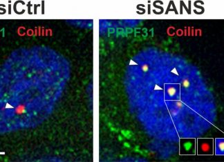 Splicing Dysfunction Identified in Usher Syndrome