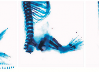 Researchers discover unknown childhood genetic condition and its potential cure