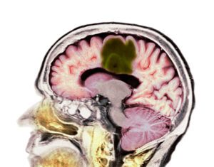 Common Mutation in Gliomas Sensitizes Them to Immunotherapy