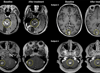 World-first clinical trial demonstrates focused ultrasound can deliver antibody therapy to breast cancer metastases in the brain