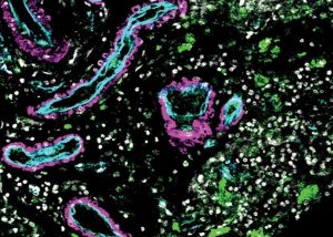 Atlas of Brain Vasculature Identifies New Cell Types and Links Immune Cells with Hemorrhagic Stroke