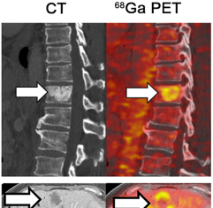 Cancer Cell Iron Addiction Exploited to Target Drug Conjugate to Tumors
