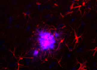 Researchers study how gene expression changes in the brain in Alzheimer’s disease