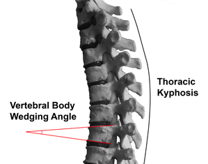 What explains our lower back pain? Anthropologists turn to Neandertals for answers
