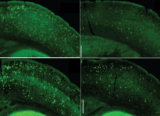 Key signaling pathway in immune cells could be new Alzheimer’s target