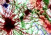 URMC Partners with Sana Biotechnology to Advance Cell-based Therapies in Neurological Disorders – URMC