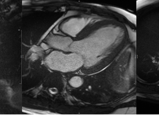Heart muscle scarring found in patients with hypertension are associated with worse outcomes