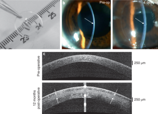 Accessible bioengineered corneal tissue to address a blinding disease globally – Nature.com