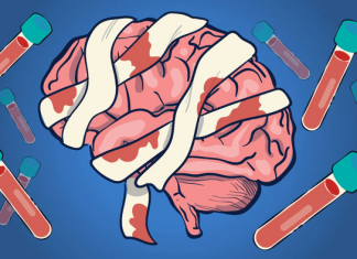 Early blood tests predict death, severe disability for traumatic brain injury
