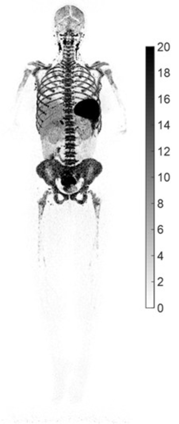 UC Davis’ new research shows how total-body PET imaging can assess the immunological response to COVID-19 infections