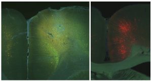 Visual Memory Impeded When Alzheimer’s Degrades Cells That Cross Brain Hemispheres