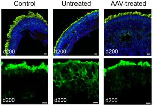 Potential Gene Therapy Developed for Childhood Blinding Disease