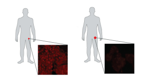 Prostate Cancer Treatment May Rewire Tumor Engine, Potentially Increasing Aggressiveness
