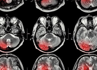 Residential exposure to petroleum refining could be related to strokes in the southern United States