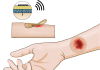 Chronic Wounds Heal Quicker with Smart Bandages