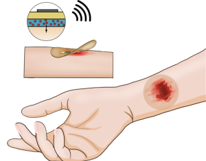 Chronic Wounds Heal Quicker with Smart Bandages