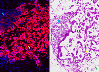 NIH grant funds cancer prevention vaccine research