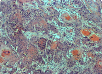 Research on rare genetic disease sheds light on a common head and neck cancer