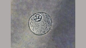 3D Organoid Model Developed for Gastroesophageal Junction Cancer