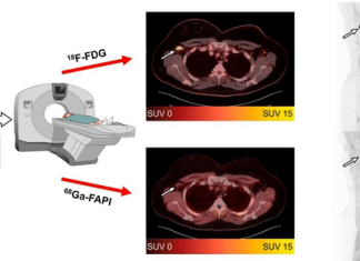 Novel PET radiotracer reduces number of false-positive cancer findings after COVID-19 vaccination