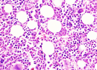Study reveals how chronic blood cancer transitions to aggressive disease
