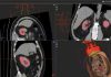 HistoSonics Announces FDA Approval of its Pivotal IDE #HOPE4KIDNEY Trial