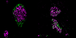 Microexon Gene Fragments in Islet Cells Could Represent New Diabetes Targets