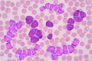 AACR News: Human Acute Myeloid Leukemia Reportedly Closely Mimicked for First Time by Transformative Models