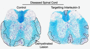 Novel Multiple Sclerosis Biological Pathway Uncovered