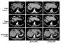 ISCT 2023: Late-breaking SCG101 Data Show 100% HBsAg+ Hepatocyte Eradication and 74.5% HCC Tumour Reduction With Single Dose HBsAg-specific TCR-T Cell Therapy