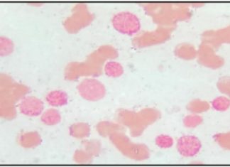 A novel chromosomal abnormality in AML patient: Case report and literature review