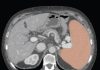 AI with volumetric thresholds facilitate opportunistic screening for splenomegaly