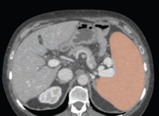 AI with volumetric thresholds facilitate opportunistic screening for splenomegaly