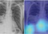 Deep-learning chest radiograph model predicts mortality for community-acquired pneumonia