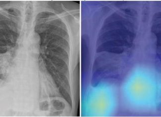 Deep-learning chest radiograph model predicts mortality for community-acquired pneumonia