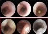 Colon Cancer Accelerated by Age-Related Changes in Blood System