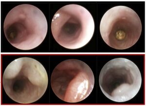 Colon Cancer Accelerated by Age-Related Changes in Blood System