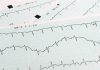 New method for assessing the structural changes in cardiac arrhythmia