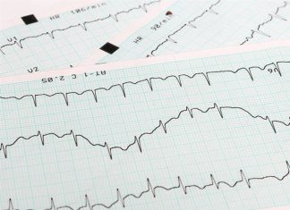 New method for assessing the structural changes in cardiac arrhythmia
