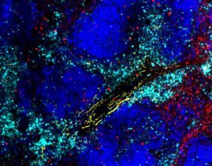 Beta Blockers Revive Immune Cells Exhausted by Stress Hormone