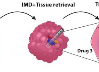Human Brain Tumor Implant Could Guide Personalized Therapies