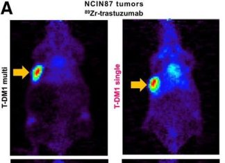 PET imaging validates use of common cholesterol drug to enhance HER2-targeted cancer therapy