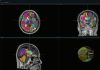 VUNO Secures FDA 510(k) Clearance for VUNO Med®-DeepBrain®