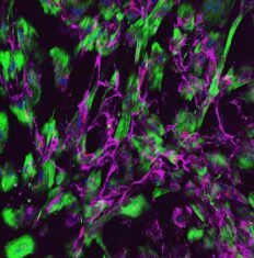 Patient Cell-Derived Models Point to Therapeutic Options for Mutation-Linked Small Vessel Disease